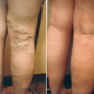 Varicose Veins: What to Know