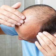 Feel Confident and Attractive With Hair Restoration in Connecticut