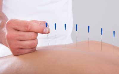 Relieve Stress with Acupuncture Services in Newark, CA: A Guide to Holistic Health