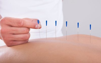 How You Can Benefit From Acupuncture for Pain in Berkeley CA and Improve Daily Comfort