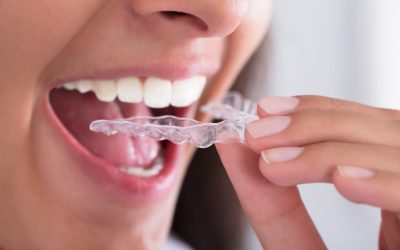 Unlock A Confident Smile With Braces In Medina OH For Lasting Oral Health Benefits